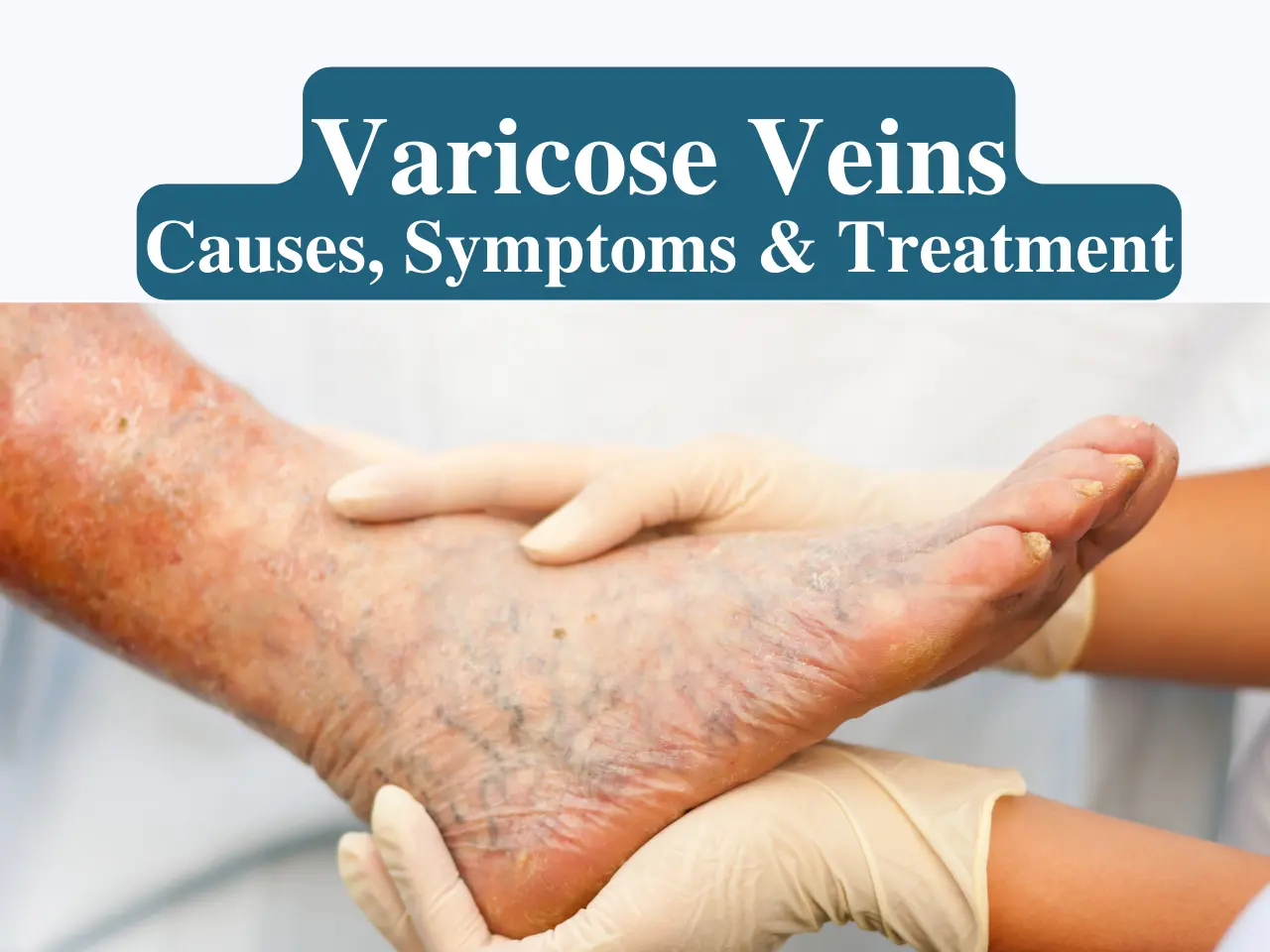 Varicose Veins: Causes, Symptoms and Treatment