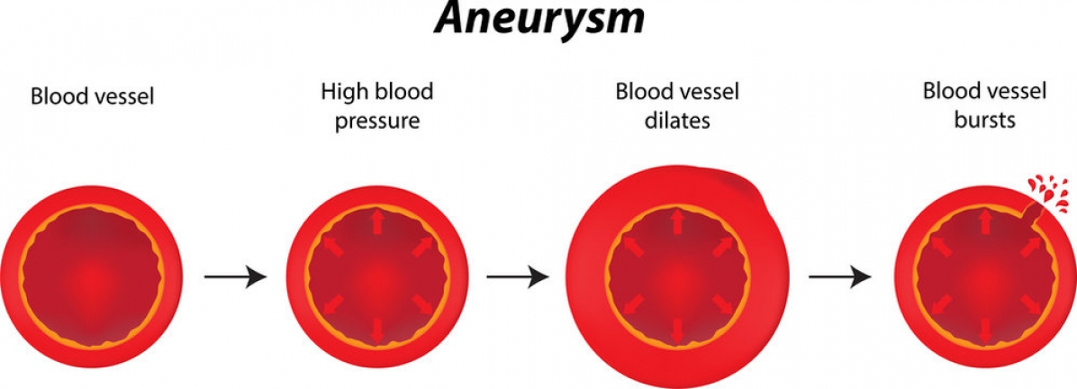 Brain Aneurysm blood