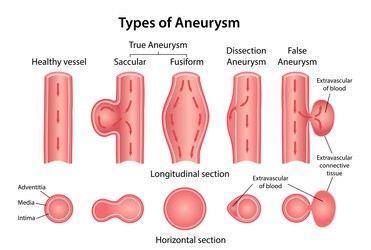 Types of brain aneurysm