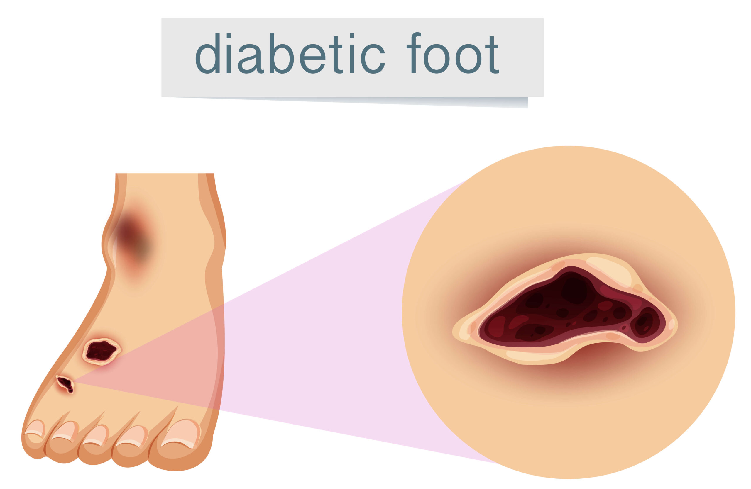 diabetic foot