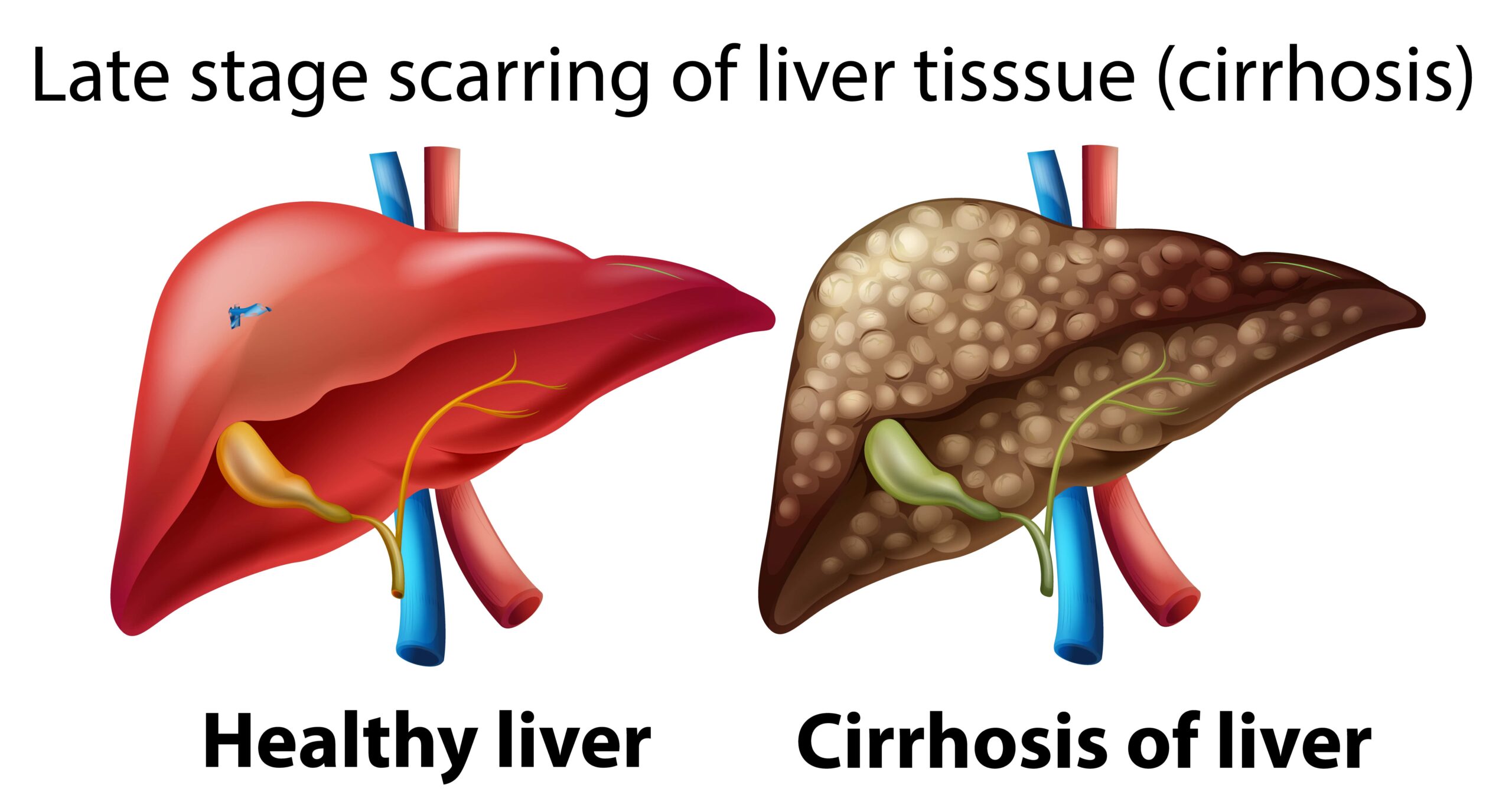 healthy and damage liver-min