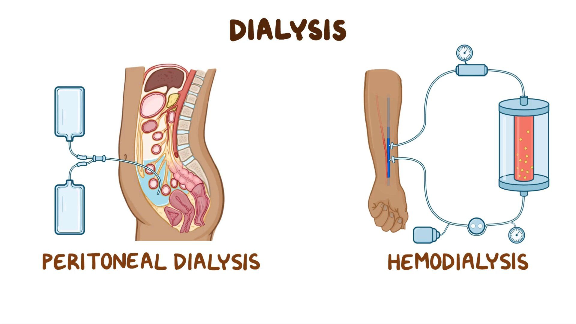 types of kidney dialysis