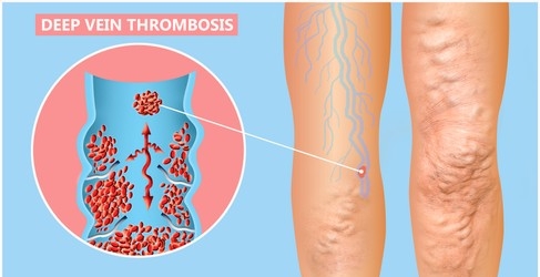 Connection Between Varicose Veins and Deep Vein Thrombosis