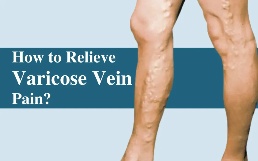 How to Relieve Varicose Vein Pain?