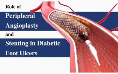 Peripheral Angioplasty for Diabetic Foot Ulcers