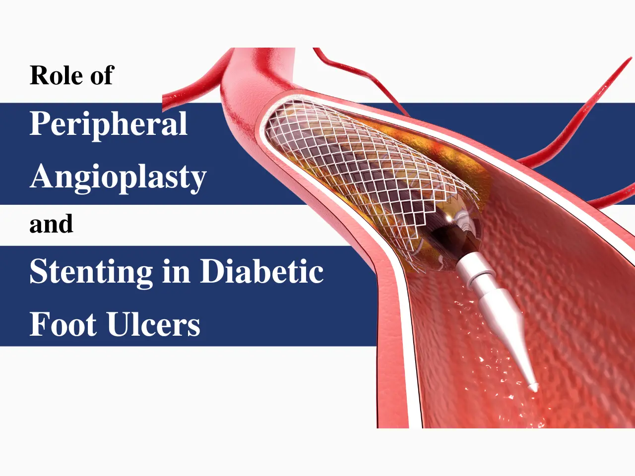 Role of Peripheral Angioplasty and Stenting in Diabetic Foot Ulcers
