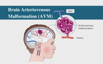 What is Brain Arteriovenous Malformation?
