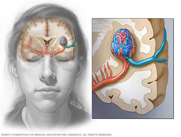 Brain Arteriovenous Malformation