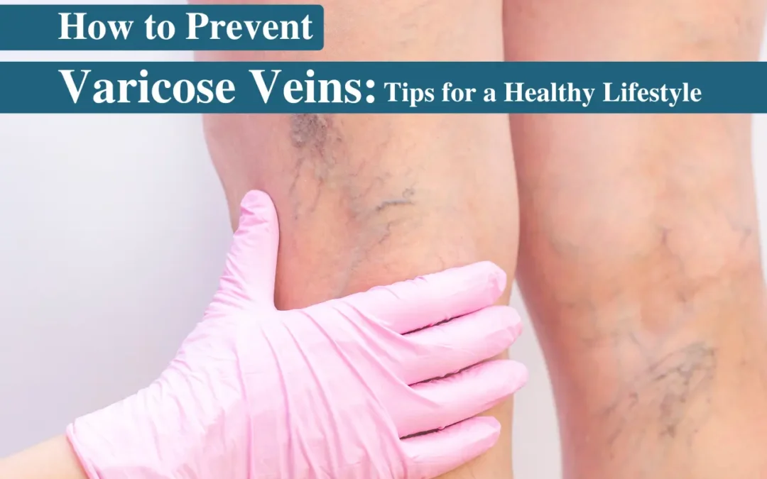 How to Prevent Varicose Veins?