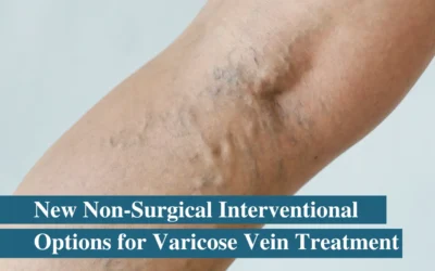 New Non-Surgical Treatments for Varicose Veins