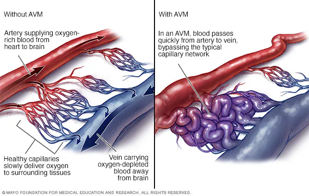 without AVM and with AVM