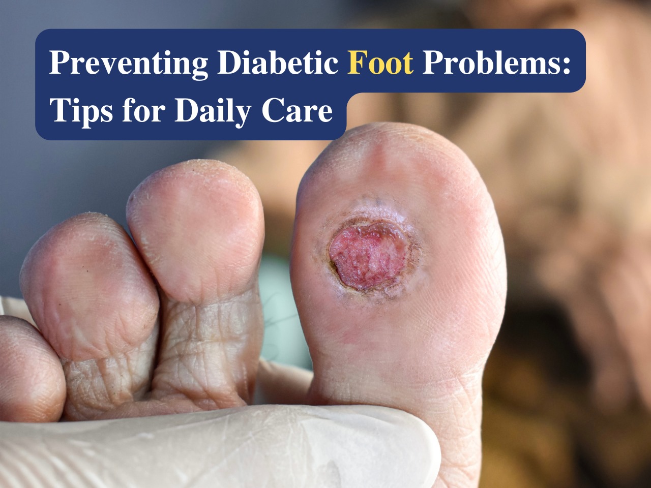 Tips for Preventing Diabetic Foot Problems Expert Advice