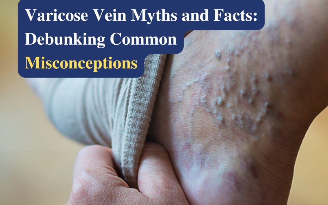 Varicose Vein Myths and Facts