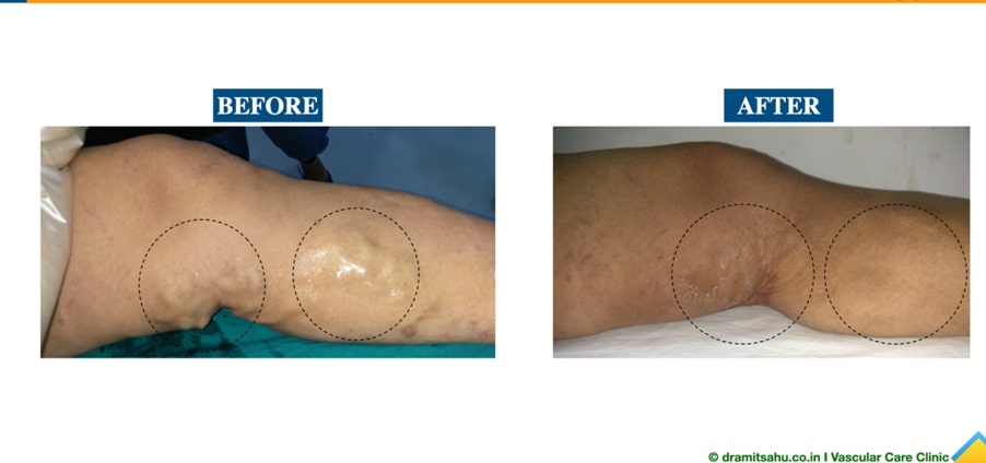 After and Before leg varicose veins treatment