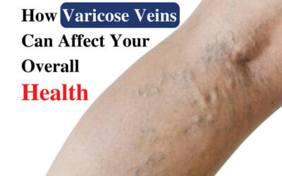 How Varicose Veins Can Affect Your Overall Health?