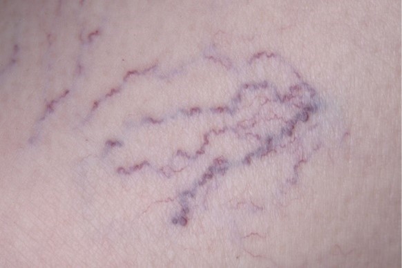 Visible veins with a blue or purple hue