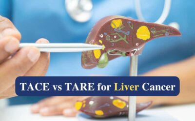 TACE vs TARE for Liver Cancer