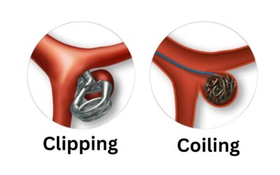 Coiling vs Clipping: Latest Innovations in Brain Aneurysm Treatment