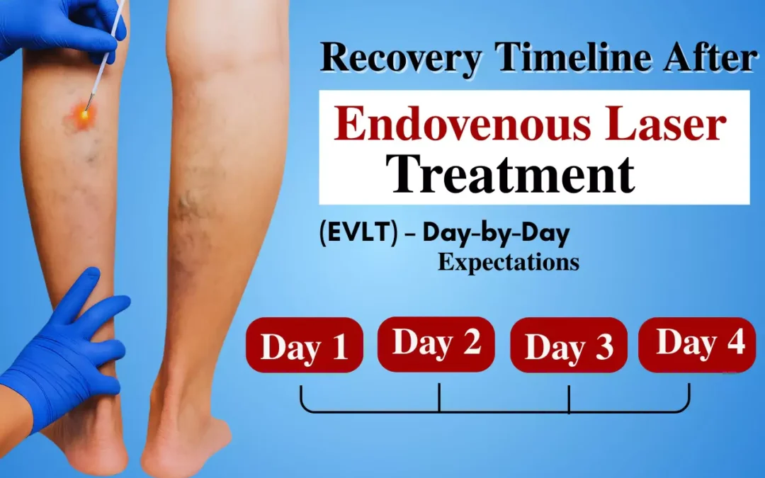 Recovery Timeline After Endovenous Laser Treatment