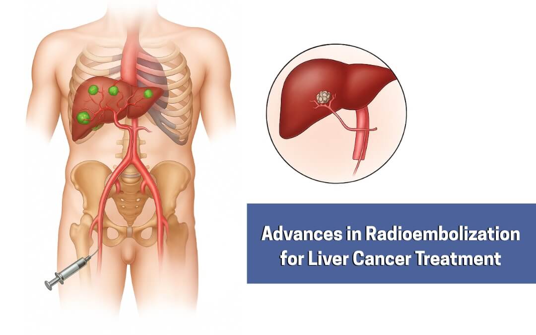 Advances in Radioembolization for Liver Cancer